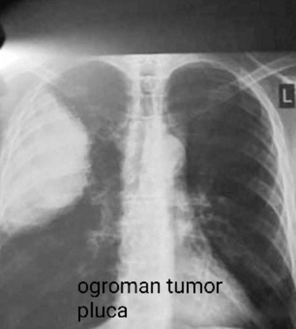 Nalaz koji pokazuje ogroman tumor pluća