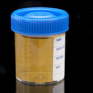 AKO STE OVO VIDELI NA NALAZU - NE ČEKAJTE! Povišeni leukociti u urinu nisu bezazleni - TIHI SIMPTOM PRAVI PAKAO