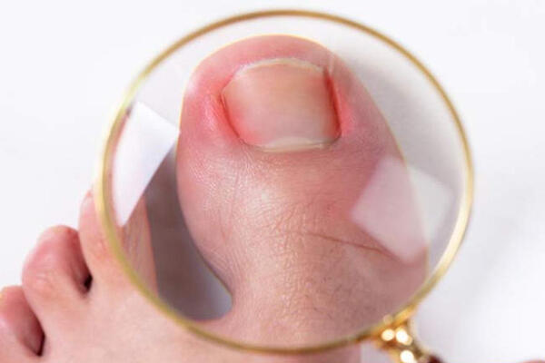 URASLI NOKTI: Kako ih izvući BEZBOLNO i nositi otvorenu obuću bez ustezanja!