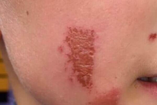 UPAO U OBE BILJKE PA UNAKAZIO SOPSTVENO LICE: Nije KOPRIVA u pitanju, JOŠ JE GORE