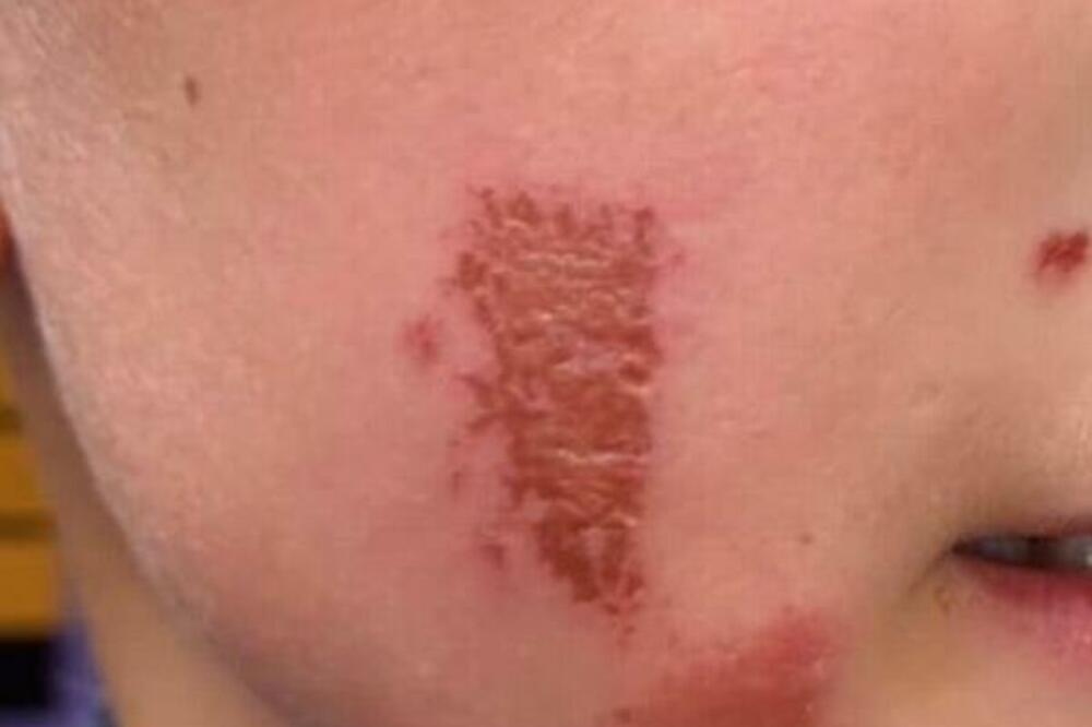 UPAO U OBE BILJKE PA UNAKAZIO SOPSTVENO LICE: Nije KOPRIVA u pitanju, JOŠ JE GORE