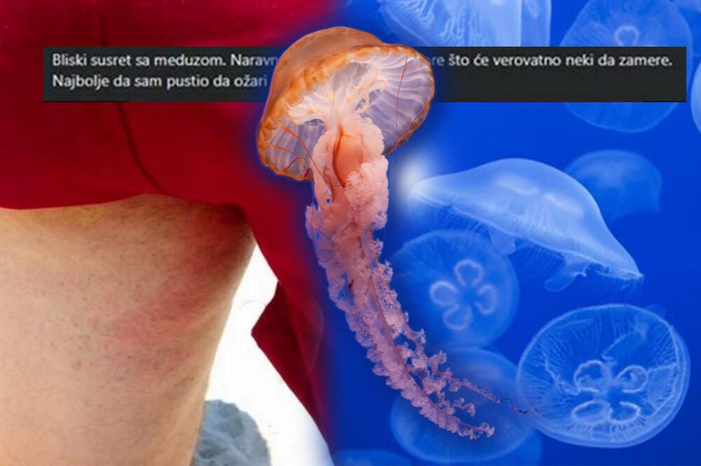 "D' IZVINEŠ DRUŽE, MOGLO JE I GORE": Srbin pokazao opekotinu od meduze, SVI PLAČU od SMEHA zbog 1 stvari (FOTO)