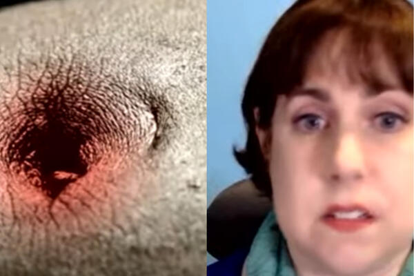 UGLEDALA JEZIVU STVAR NA PUPKU, PA SAZNALA DA UMIRE: Sada smo svi u opasnosti (VIDEO)