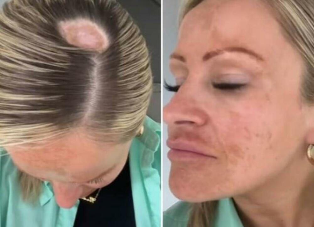 Rak kože, Pečati, Glava