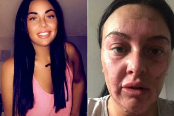 ZBOG TRIKA NA TIKTOKU SEBI SPRŽILA LICE: Sve devojke su poludele za OVIM,evo na šta upozorava, JEZIVO JE! (VIDEO)