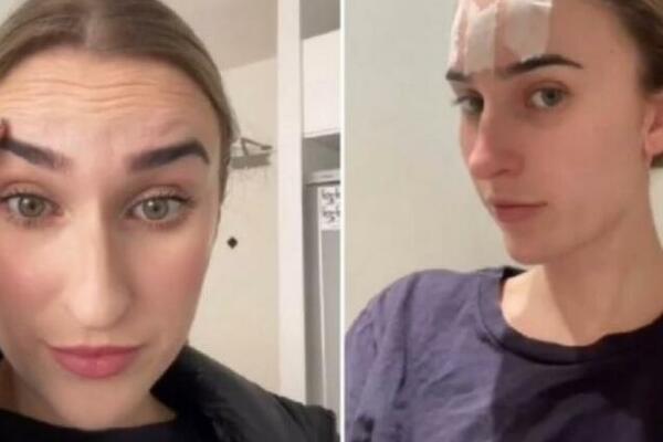 SPAVALA JE SA SELOTEJPOM PREKO ČELA 7 NOĆI ZBOG BORA: Plastični hirurg otkrio da li je ZDRAVO, FRAPIRAĆETE se!