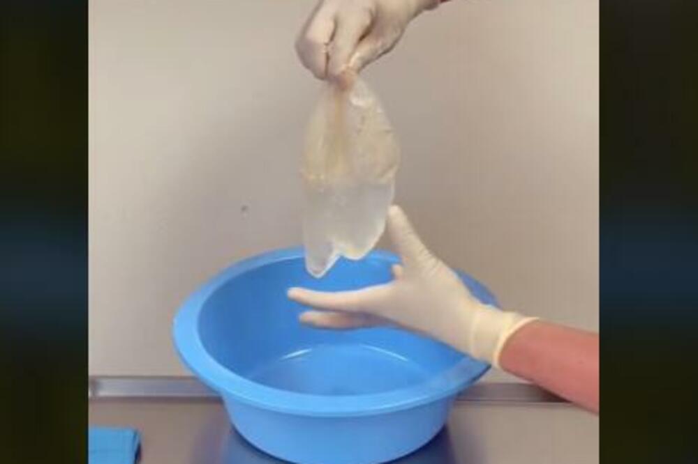 ESTETSKI HIRURG POKAZAO SILIKONE STARE 30 GODINA: Iz njih izašla OVA GADNA STVAR (VIDEO)