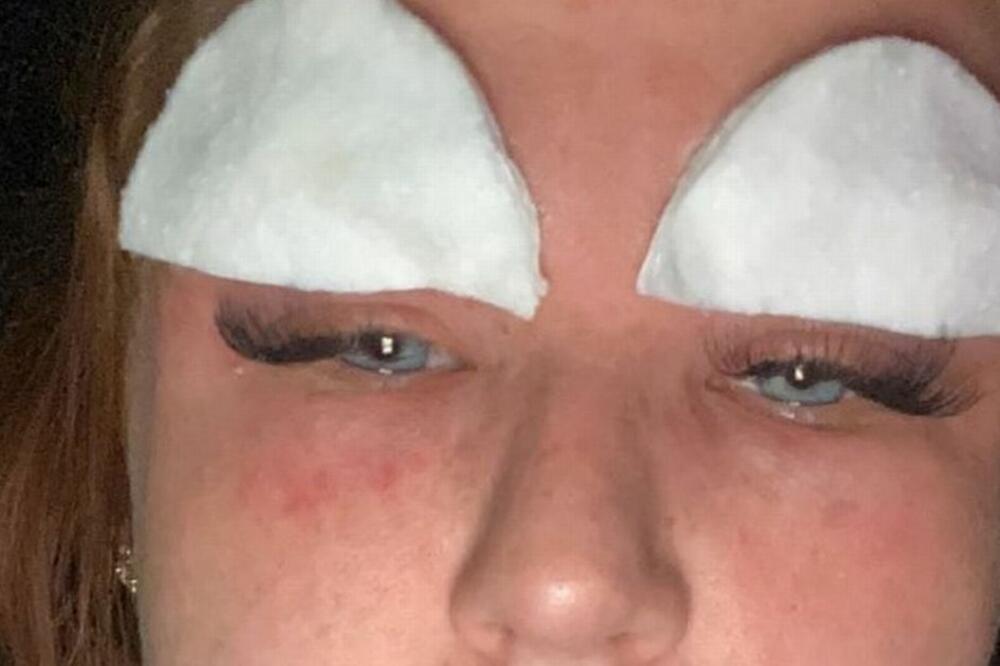 "KOMADI KOŽE OTPADALI SI MI S OBRVAMA, A ONDA JE POČELO GUŠENJE": Išla da nadogradi TREPAVICE pa NADRLJALA! FOTO