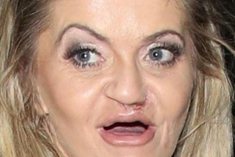 "TRUNU MI JAGODICE ZBOG KOKAINA!" DANIJELI JE DROGA UNIŠTILA I ŽIVOT I LICE, a sada su isplivali JEZIVI DETALJI!