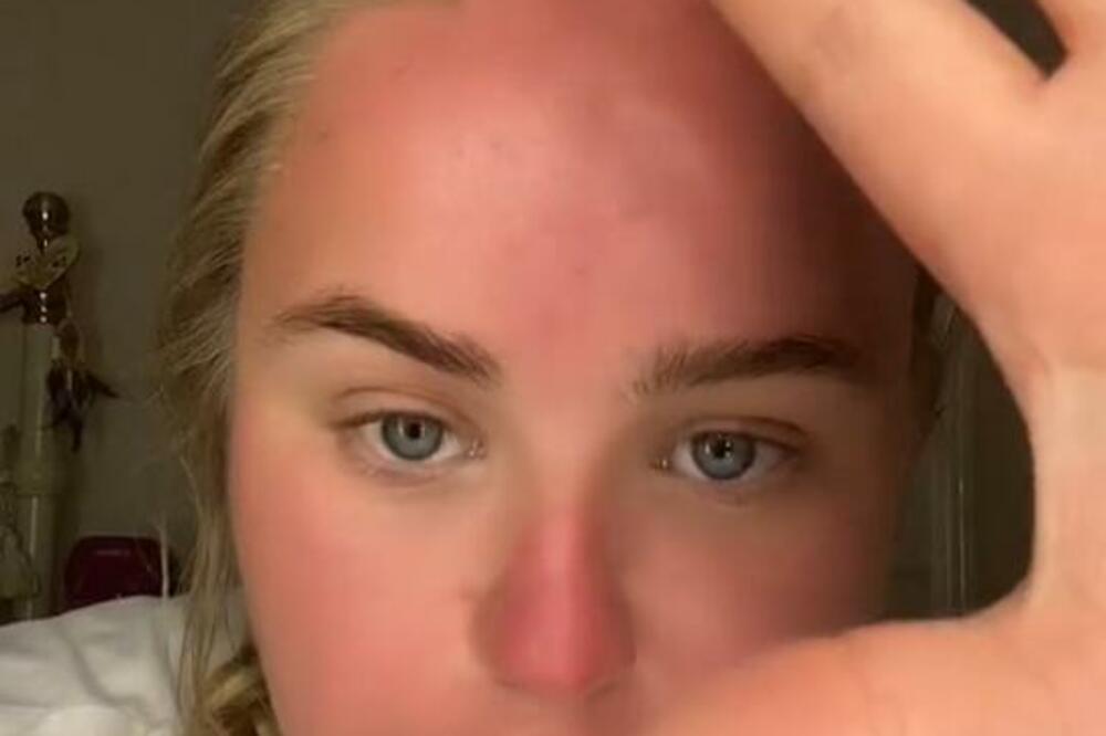 ČUVAJTE SE OVAKVOG SUNCA: Evo šta se desilo DEVOJCI posle samo SAT VREMENA na OTVORENOM, ŠOK PRIZOR NA TELU (VIDEO)