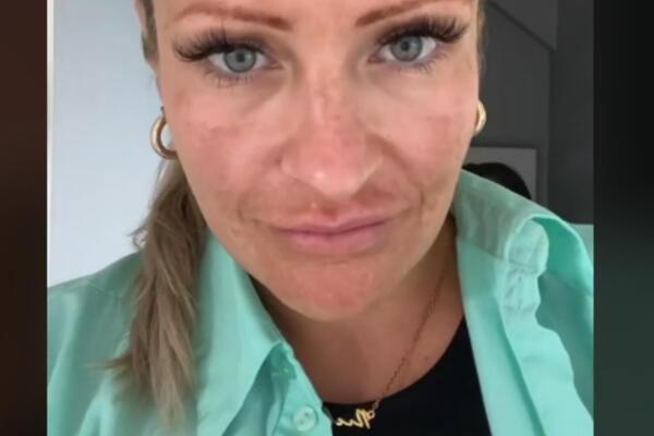 OSTALA JOJ JE RUPA NA GLAVI, KOJU SU KRPILI S NOGE! Ova ŽENA je uradila ono što SVE SRPKINJE RADE (VIDEO)