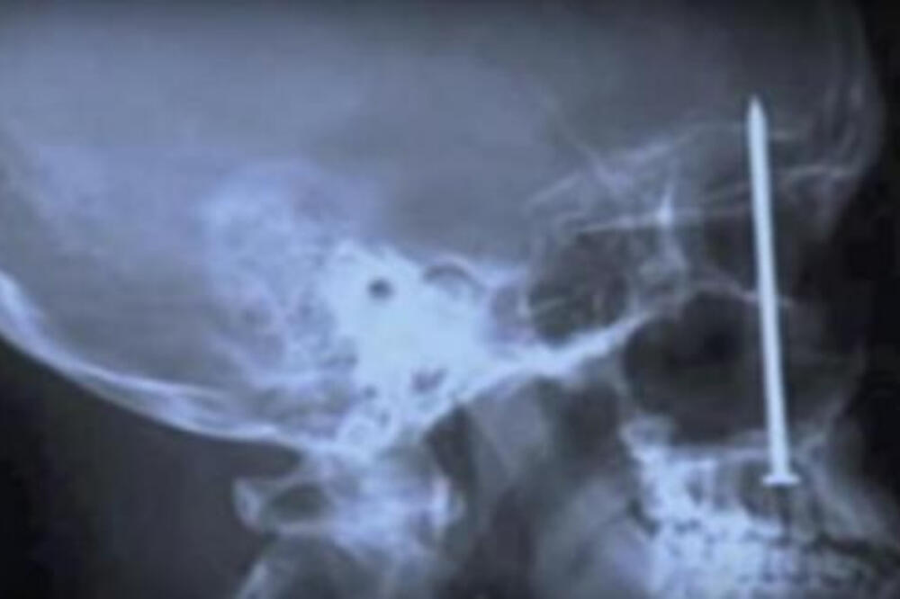 NAJBIZARNIJE STVARI NAĐENE U LJUDSKOM TELU: Sve je snimljeno rendgenom, NAJEŽIĆETE SE! (VIDEO)