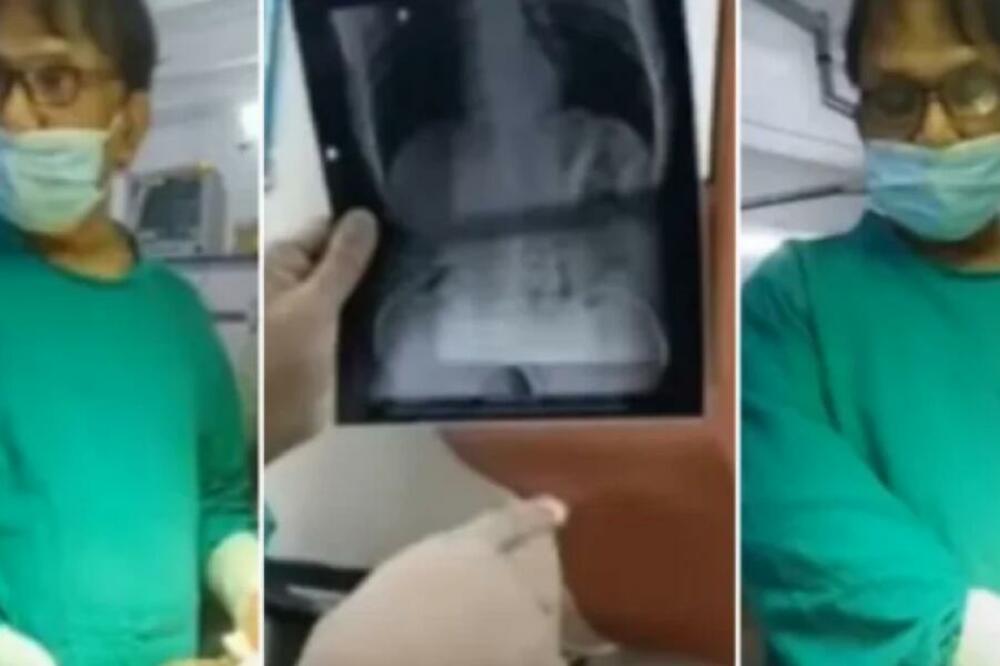 OTIŠAO NA JEDNO PIĆE, PA ZAVRŠIO U BOLNICI: U stomaku mu je bilo OVO, gledate na sopstvenu odgovornost (VIDEO)