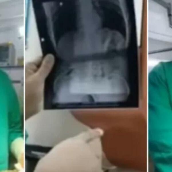 OTIŠAO NA JEDNO PIĆE, PA ZAVRŠIO U BOLNICI: U stomaku mu je bilo OVO, gledate na sopstvenu odgovornost (VIDEO)