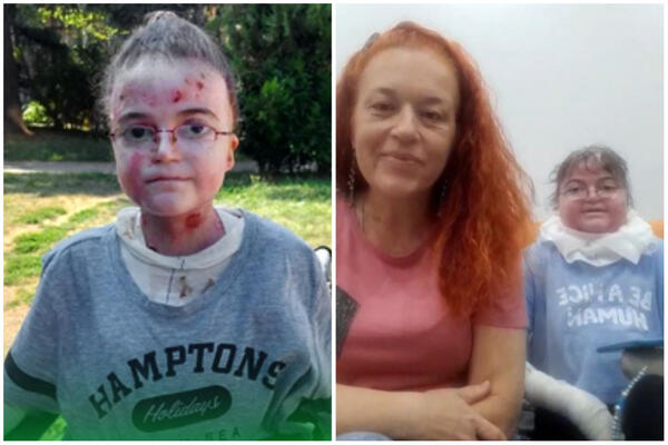 ANA (20) JE DETE LEPTIR, BOLI JE SVAKI DODIR, U SVAKOM MOMENTU: Sa majkom licitira stvari da bi se LEČILA! (FOTO)