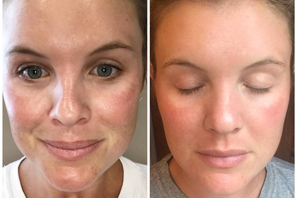 ČAROBNI DERMAROLER: Uklanja bore i fleke sa lica, podmlađuje i ujednačava ten!