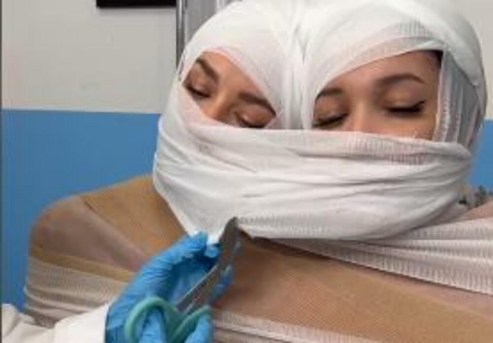 Sijamski blizanci, Blizankinje