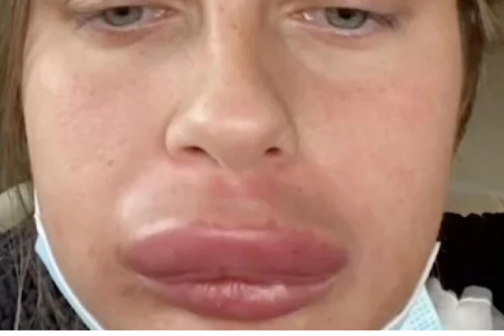 OTIŠLA DA URADI USNE, OTEKLA JOJ CELA GLAVA: U teškom stanju završila U BOLNICI, cela slika je JEZIVA