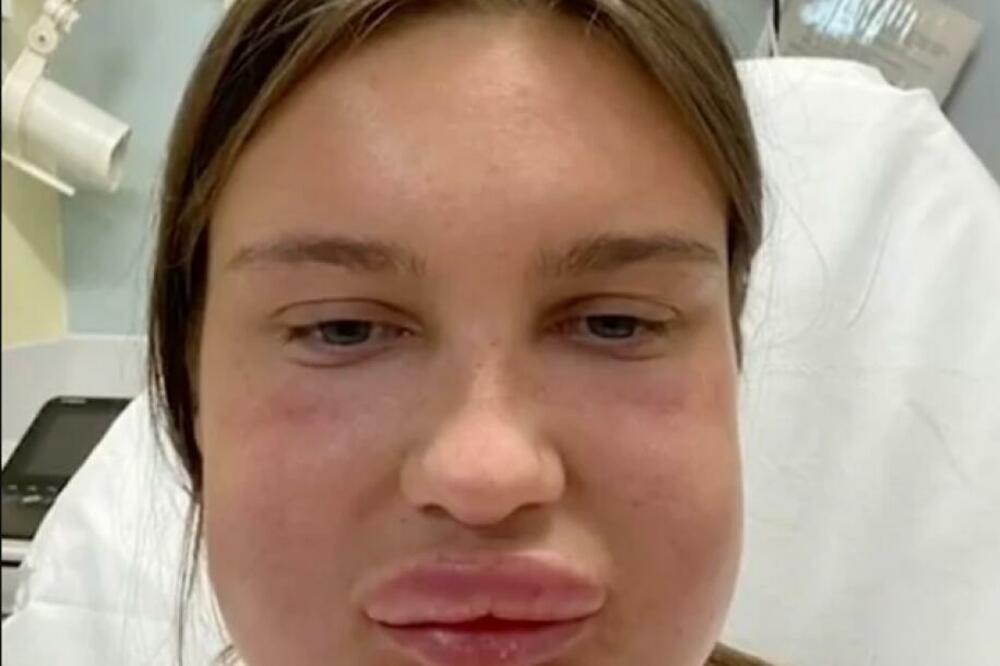 NADA ZA ONE KOJI IMAJU ALERGIJU NA JAJA: Nova ISTRAŽIVANJA došla do ŠOK OTKRIĆA