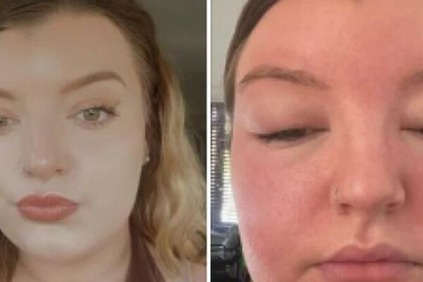 KATASTROFALNE POSLEDICE ZANEMARIVANJA SIMPTOMA: Ovo je važno da znate ako boravite na SUNCU, ona se pokajala!