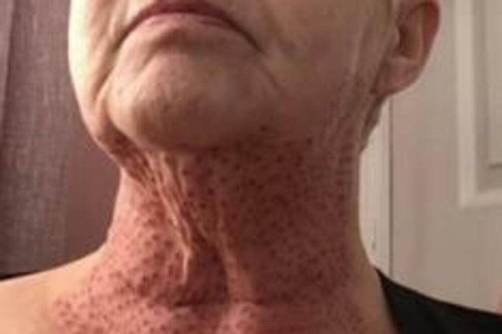 VRAT MI JE IZGLEDAO KAO OD GUŠTERA! Žena otišla da se PODMLADI, A IZAŠLA NEPREPOZNATLJIVA I ROĐENOJ DECI (FOTO)