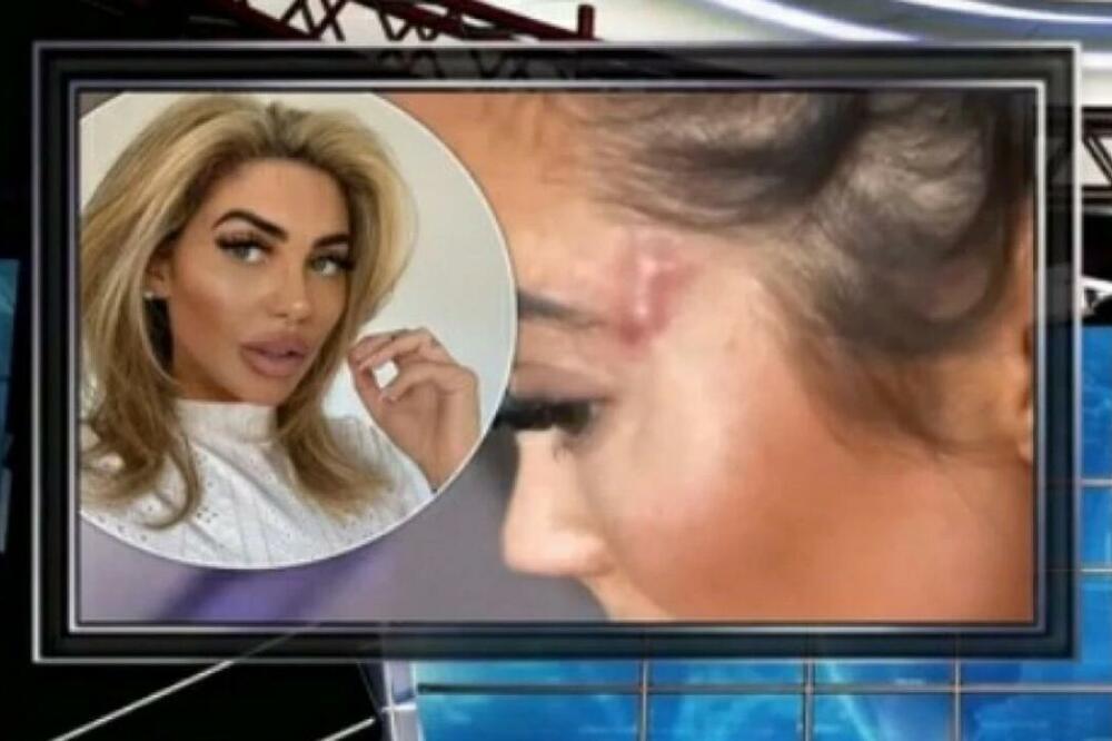 RIJALITI ZVEZDA DOŽIVELA PRAVI HOROR! Otišla da se ulepša a plastičar joj bukvalno OSAKATIO LICE! (VIDEO)