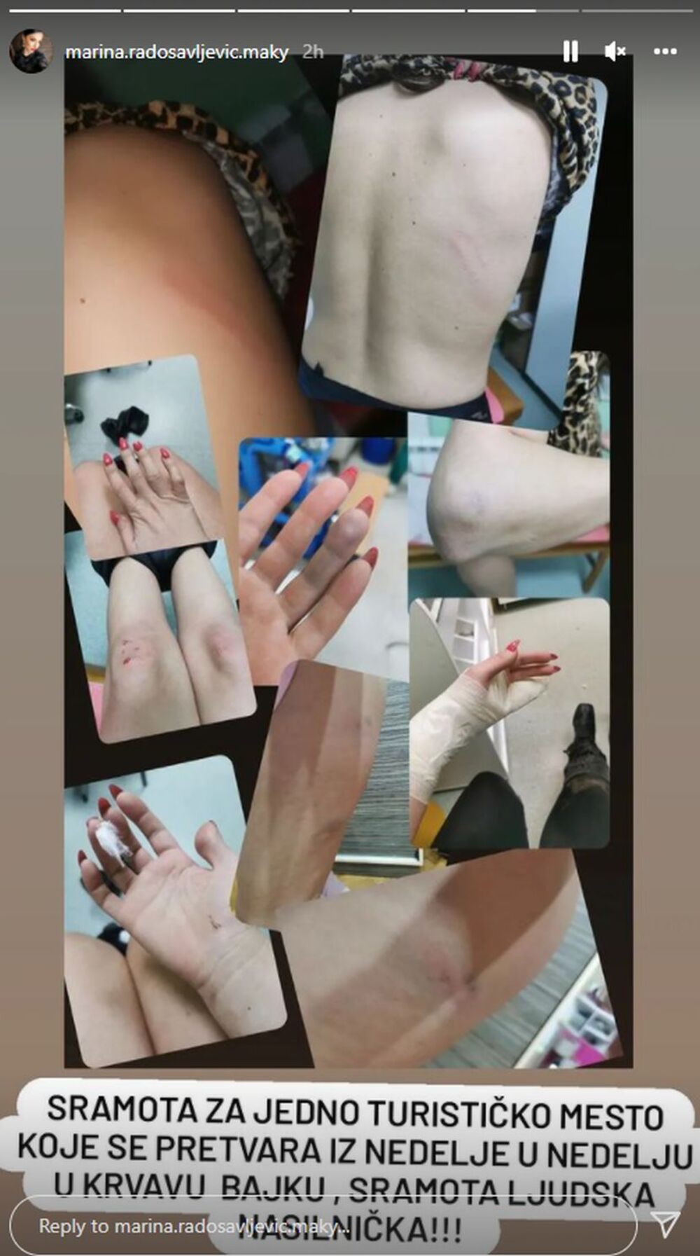 I tada je završila u bolnici, sa polomljenom rukom, sva u podlivima i modricama