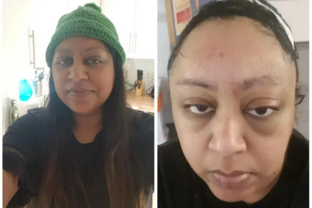 REKLI DA IMA UPALU SINUSA, A ONDA JOJ SE BORILI ZA ŽIVOT: Bilo je gore nego što su mislili! (FOTO)