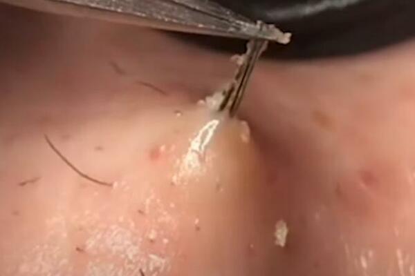 Šta da radite ako vam je urasla dlaka posle brijanja? Zbog jedne stvari morate u bolnicu, opasno je