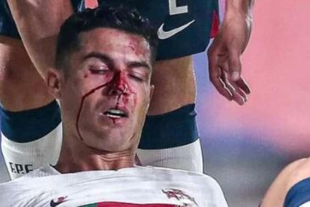 KOBNA NOĆ ZA RONALDA! Krv preko celog lica, GROZAN UDARAC (VIDEO)