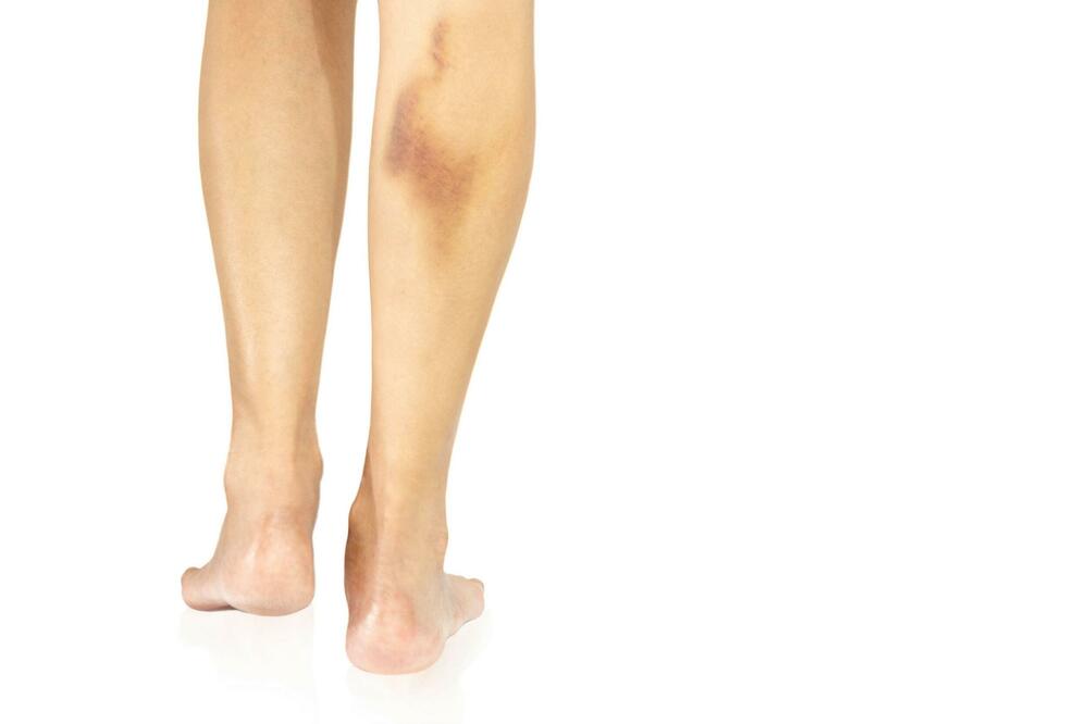 ČESTO VAM IZLAZE MODRICE PO TELU? Ovo je razlog i način da ih sprečite!