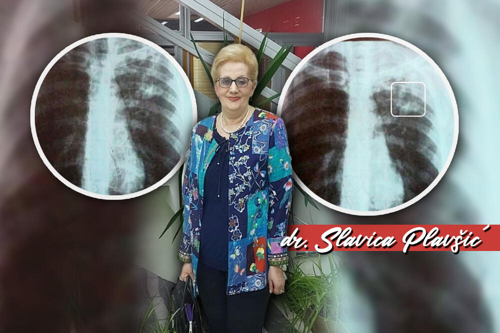 TUBERKULOZA U SRBIJI: Doktorka Plavšić za Espreso otkrila SIMPTOME opasne BOLESTI, pazite na OVO!