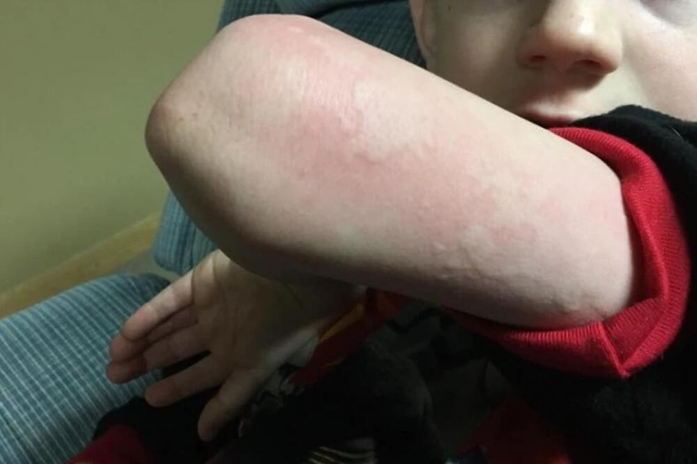 MAMA DEČAKA (8) IMA UPOZORENJE ZA RODITELJE: Dete se iz škole vratilo sa OSIPOM, LEKAR izneo neverovatnu PROGNOZU!