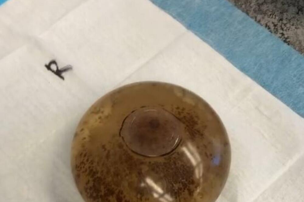 EVO KAKO IZGLEDAJU IZVAĐENI SILIKONI NAKON 1 DECENIJE: Snimak će vas naterati da POVRATITE (VIDEO)