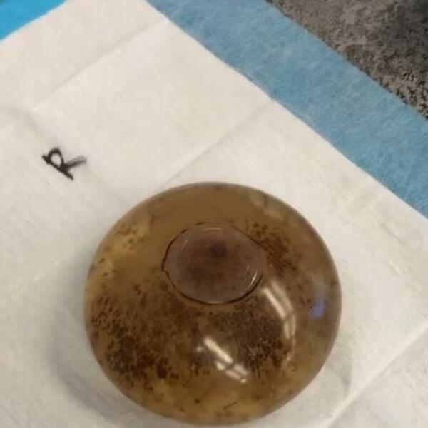 EVO KAKO IZGLEDAJU IZVAĐENI SILIKONI NAKON 1 DECENIJE: Snimak će vas naterati da POVRATITE (VIDEO)