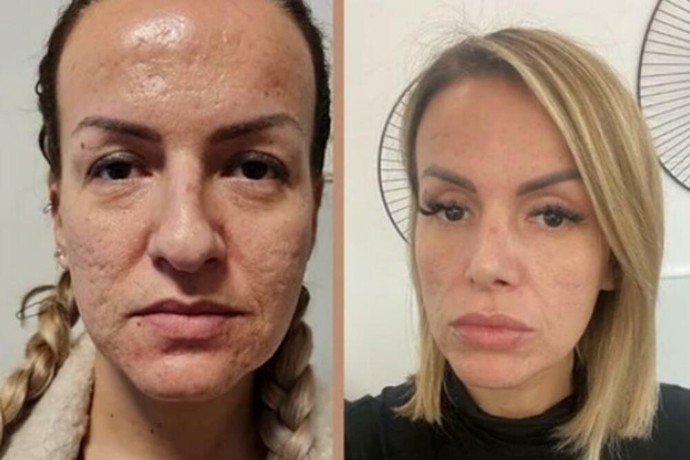 Kako je bila nezadovoljna mnogim stvarima, Pašovićeva je najveći problem bilo lice na kom je bilo mnogo ožiljaka, pa je tako, nakon što je rešila problem sa aknama, otišla na lasersko uklanjenje ožiljaka