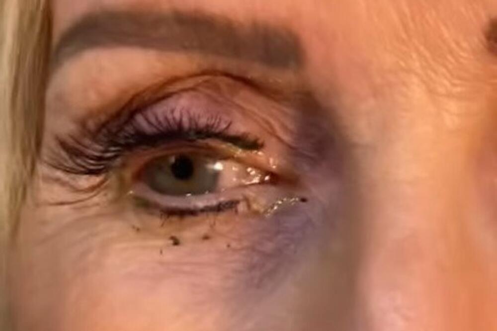DOKTORKI KATARINI SE ŽENA ŽALILA DA JE BOLI OKO: Kada vidite šta se NALAZILO u njemu, ZAPREPASTIĆETE SE (VIDEO)