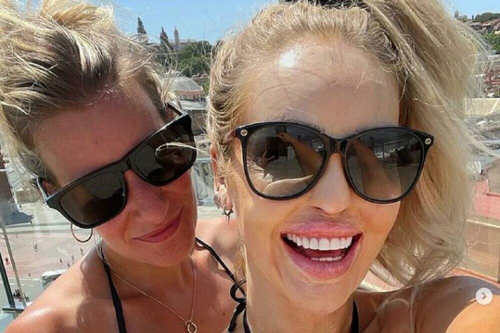 MISICU DEČKO SILOVAO 8 SATI, PA POLIO KISELINOM: Koža joj se istopila, OVAKO izgleda posle 400 operacija