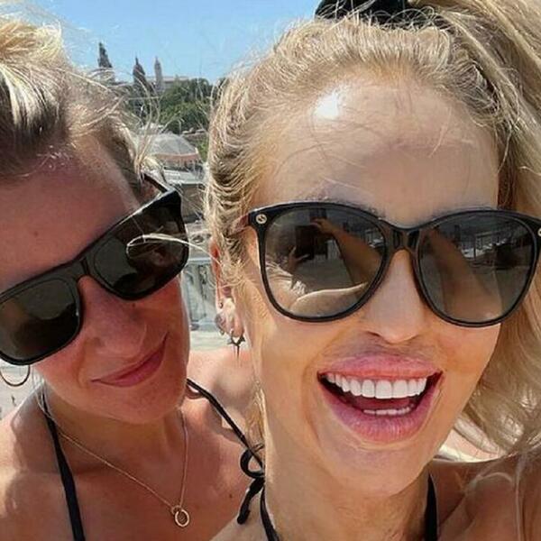 MISICU DEČKO SILOVAO 8 SATI, PA POLIO KISELINOM: Koža joj se istopila, OVAKO izgleda posle 400 operacija