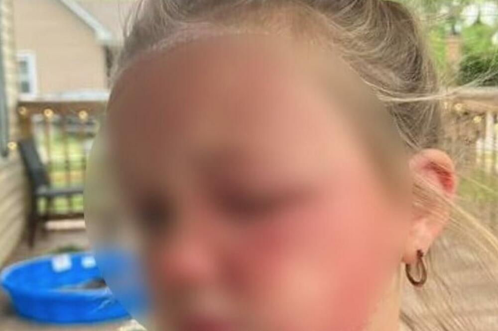 BILJKA KOJA RASTE PO DVORIŠTIMA ZAMALO UBILA DEVOJČICU (6): Počelo sa OSIPOM, a onda NIJE MOGLA DA DIŠE (FOTO)