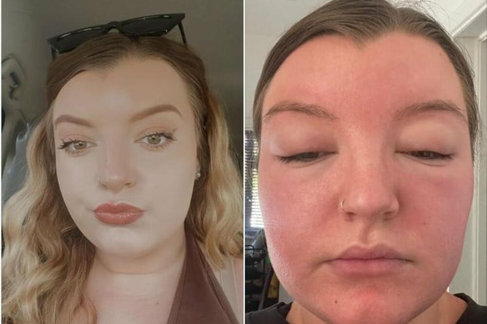 BILA JE U PROVODU I UVEČE LEGLA DA SPAVA: Probudila se sa natečenim licem, kada je otišla u bolnicu NASTAO JE ŠOK!