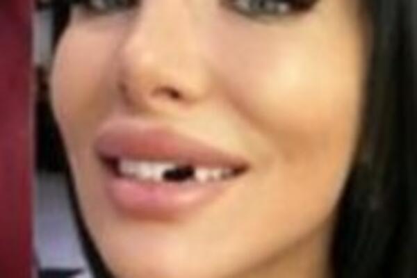 ALEKSANDRA SUBOTIĆ OSTALA BEZ ZUBA: Prizor će vas ZGRANUTI, evo šta se desilo