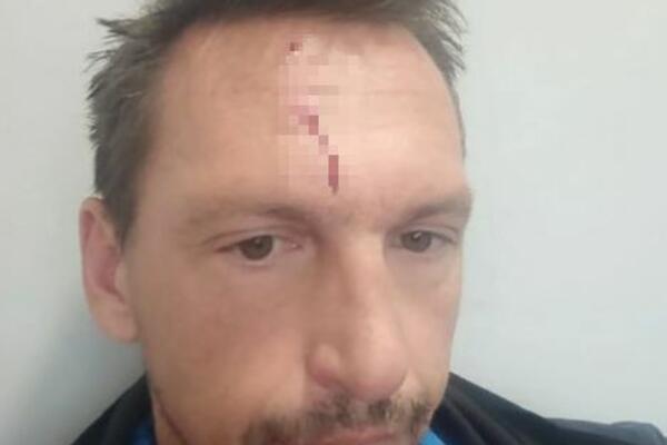 NEVIĐENI SKANDAL U SRPSKOM SPORTU! Napadnut trener Partizana - tvrdi da mu je čelnik Zvezde razbio glavu! FOTO