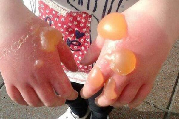 DEVOJČICA DOBILA UŽASNE OPEKOTINE: Dodirnula OPASNU BILJKU koja raste u DVORIŠTIMA, njen sok može izazvati SLEPILO!