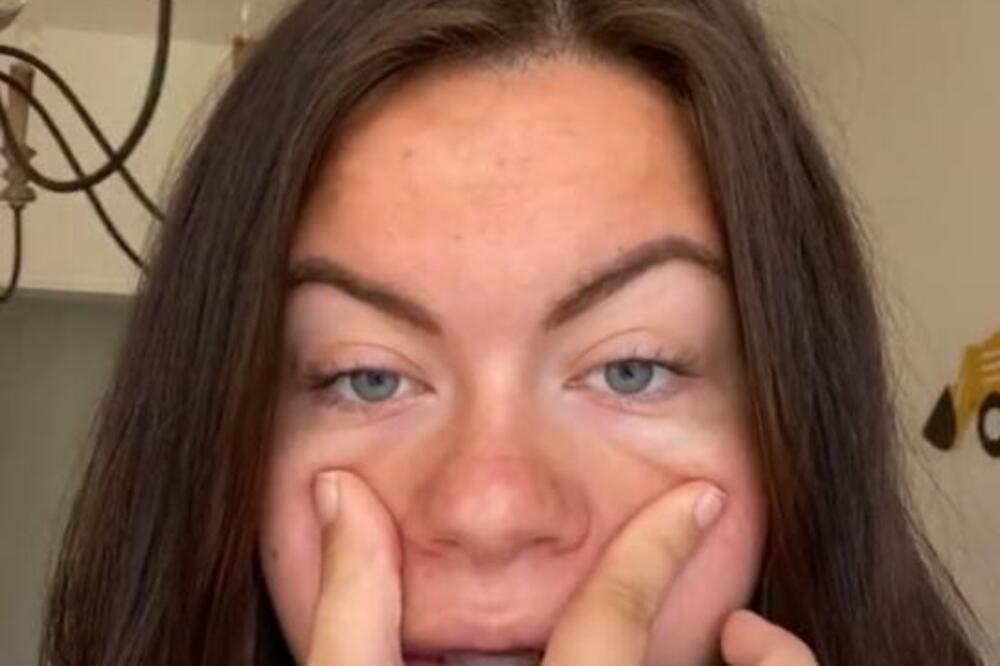 KAŽU DA SE OVO DEŠAVA KADA NOSITE DEČAKA: Žena pokazala koliko joj se IZMENIO NOS u trudnoći