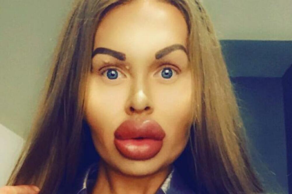 OVAJ KUVAR OD SVOJE 20. GODINE UBRIZGAVA U SEBE HUJALURON: Kada budeti videli ČITAVO LICE, onesvestićete se (FOTO)