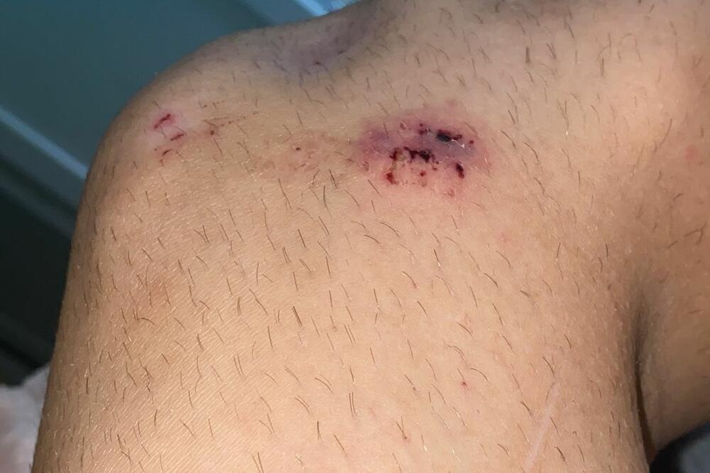 PAS LUTALICA GA OBORIO NA ZEMLJU I POČEO KRVNIČKI DA UJEDA: Drama u Bačkoj Topli, povređen MLADIĆ (FOTO)