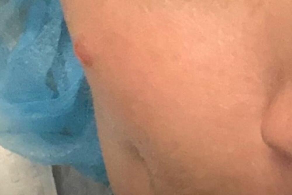 ŽENA PODELILA JEZIVO ISKUSTVO, NIJE NI SLUTILA ŠTA JOJ RASTE NA LICU: Izgledalo je kao obična CRNA MRLJA