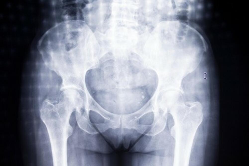 ŽENE KOJE NE JEDU MESO SU U RIZIKU OD OVOGA: Naučnici došli do ZASTRAŠUJUĆEG SAZNANJA