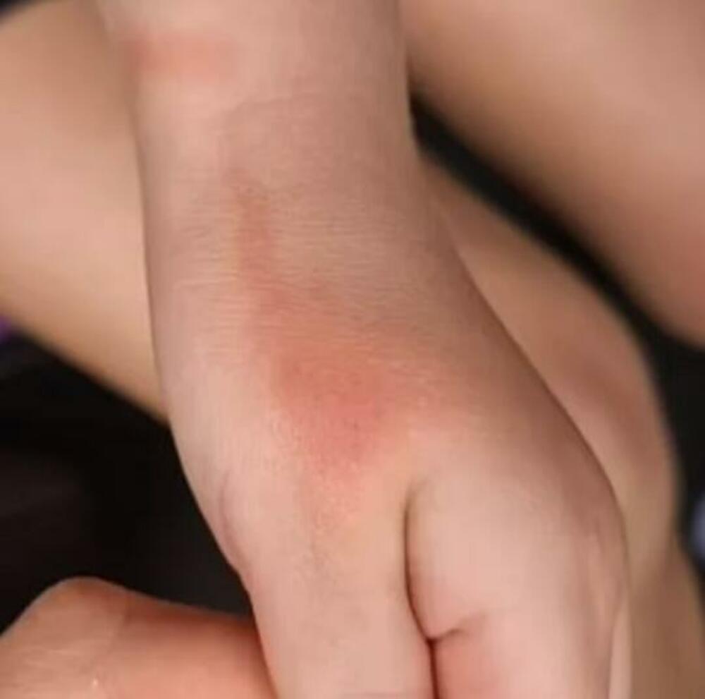 Crvene linije na koži, Koža, Ruke